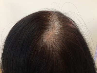 女性に多い薄毛の原因と対策について 髪のボリュームを何とかしたい ぺったんこじゃイヤ
